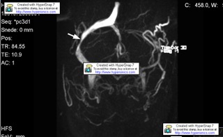 photostenosis.jpeg